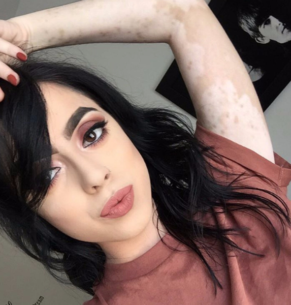 美白癜风美女勇敢晒照 倡议自爱励志感人