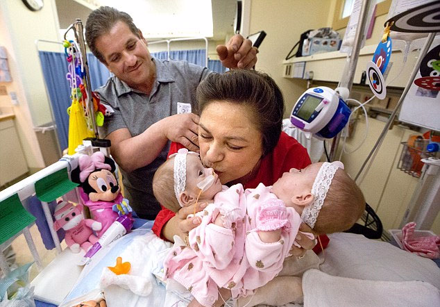 美连体女婴胸骨相连 分离手术成功率仅七成